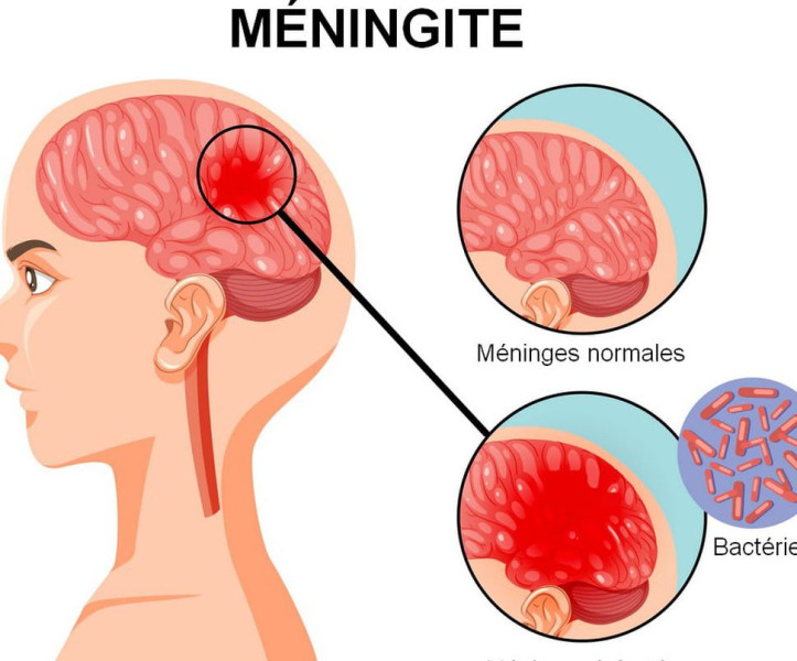 Épidémie de Méningite : La France en Alerte, mais pas en Panique